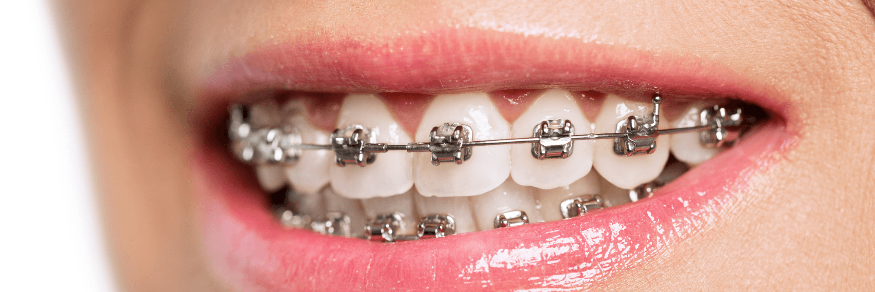 Braces for straighter whiter Smile