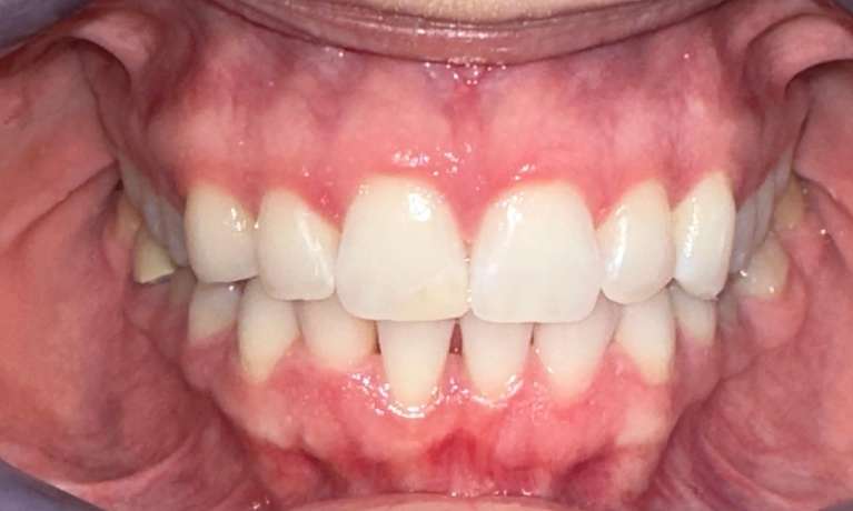 Clear-Aligners-After-Image