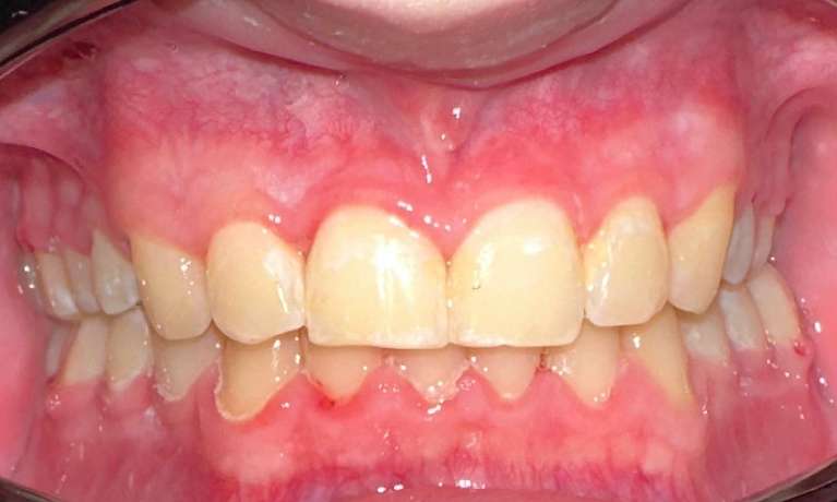 Braces-After-Image