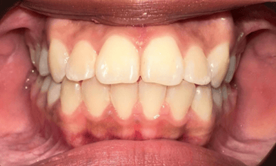 After treatment - Braces