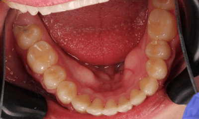 After treatment - Braces