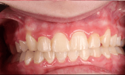 After treatment - Braces