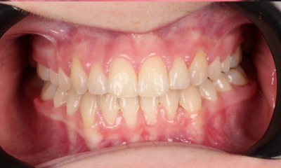 After treatment - Braces