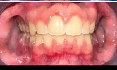 After treatment - Braces 