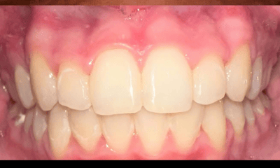 After treatment - Braces