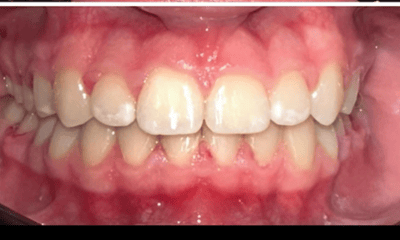 After treatment - Braces