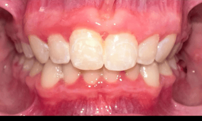 After treatment - Braces