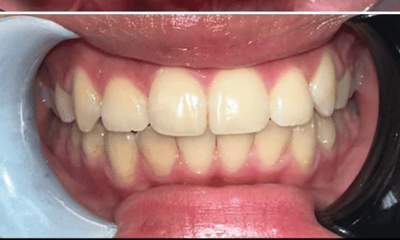 After treatment - Clear Alginers