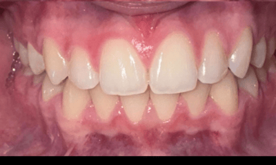 After treatment - Clear Aligners
