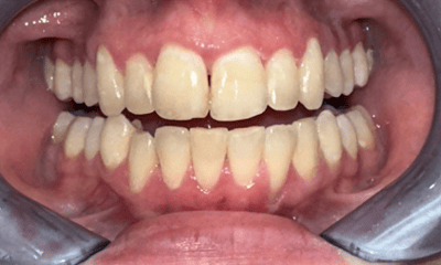 After treatment - Clear Aligners 