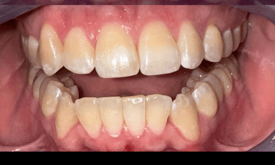 After treatment - Clear Aligners 