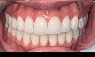 After treatment - Clear Aligners