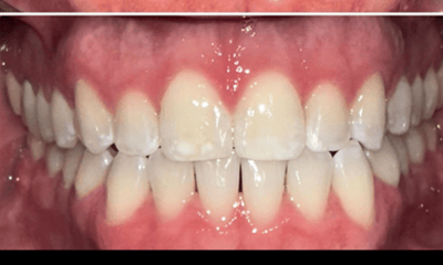 After treatment - Clear aligners