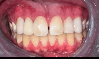 After treatment - Cosmetic Bonding