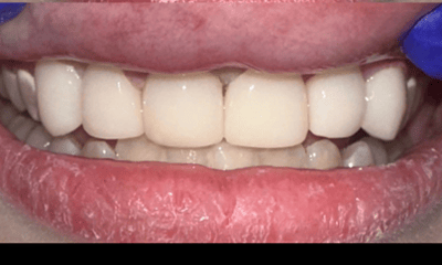 After treatment - Cosmetic Bonding