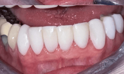 After treatment - Cosmetic Bonding