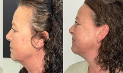 After treatment - PRF Microneedling 