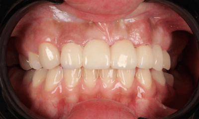 After treatment - Smile Makeover 