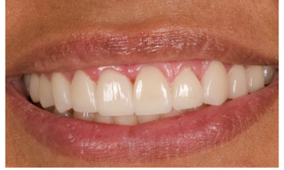 After treatment - Veneers
