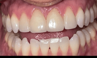 After treatment - Veneers