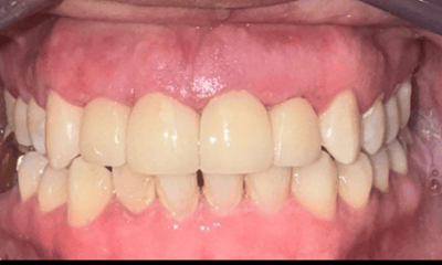 After treatment - Veneers