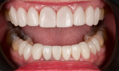 After treatment - Veneers