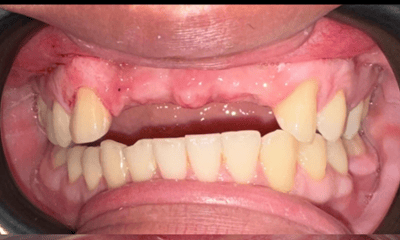 Before treatment - A Complete Smile, Restored