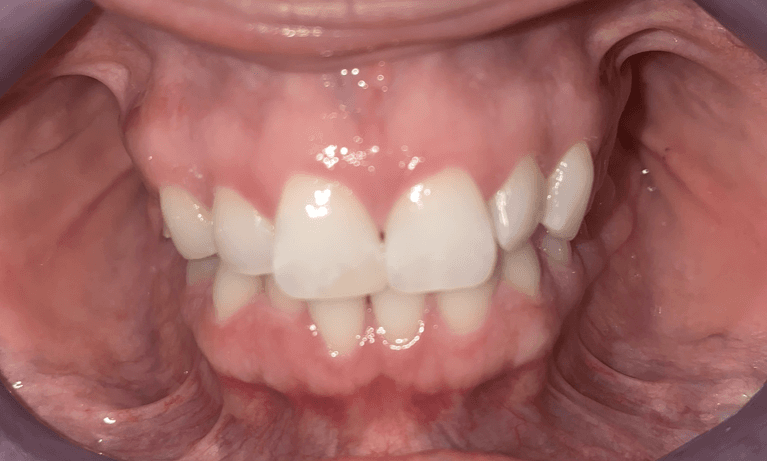 Clear-Aligners-Before-Image