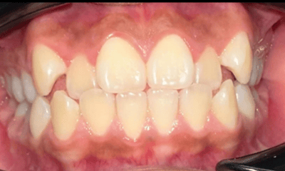 Before treatment - Braces