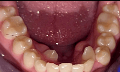 Before treatment - Braces