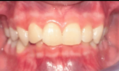 Before treatment - Braces