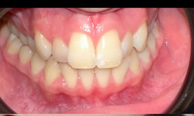 Before treatment - Braces