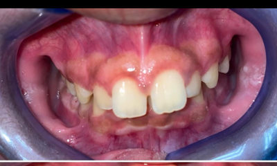 Before treatment - Braces 