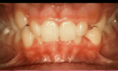 Before treatment - Braces
