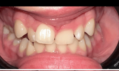 Before treatment - Braces