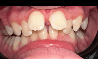 Before treatment - Braces