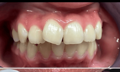 Before treatment - Clear Alginers