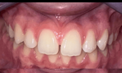 Before treatment - Clear Aligners
