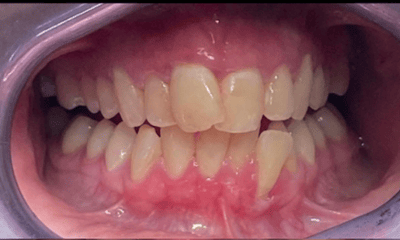 Before treatment - Clear Aligners 