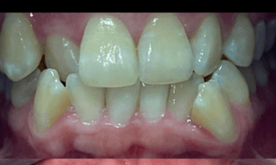 Before treatment - Clear Aligners 