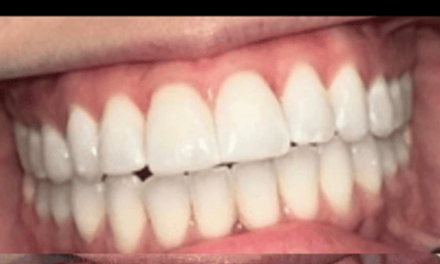Before treatment - Clear Aligners