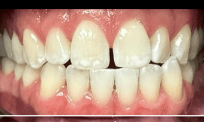 Before treatment - Clear aligners