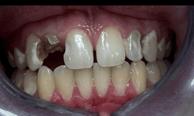 Before treatment - Cosmetic Bonding