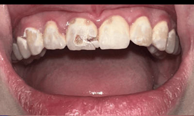 Before treatment - Cosmetic Bonding