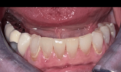 Before treatment - Cosmetic Bonding