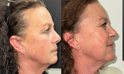 Before treatment - PRF Microneedling 