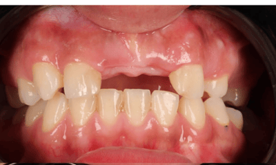 Before treatment - Smile Makeover 