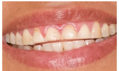 Before treatment - Veneers