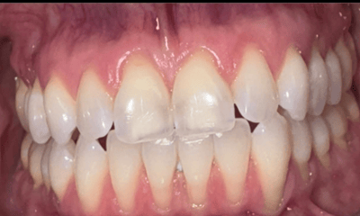 Before treatment - Veneers