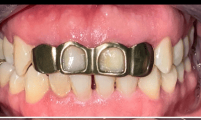 Before treatment - Veneers